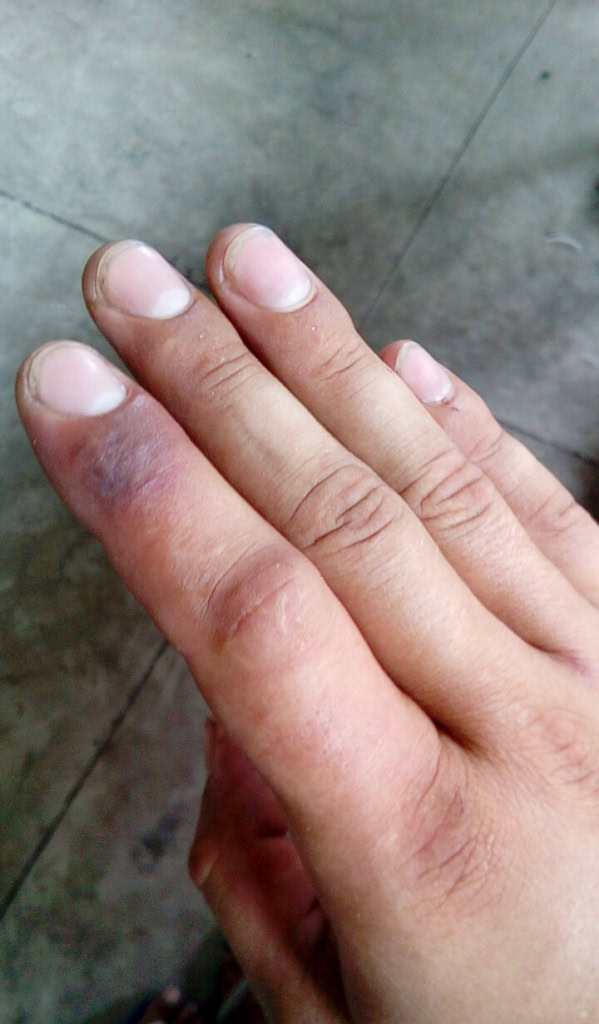 Chřestýšovec běloretý - uštknutí Kambodža