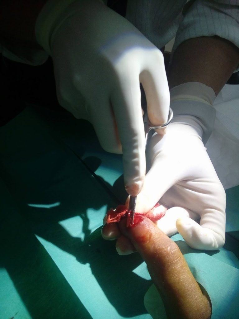 Operace po uštknutí Chřestýšovec běloretý Kambodža