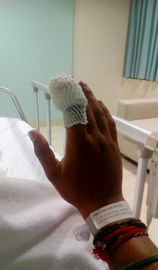 Ošetřená ruka po uštknutí Chřestýšovec běloretý Kambodža